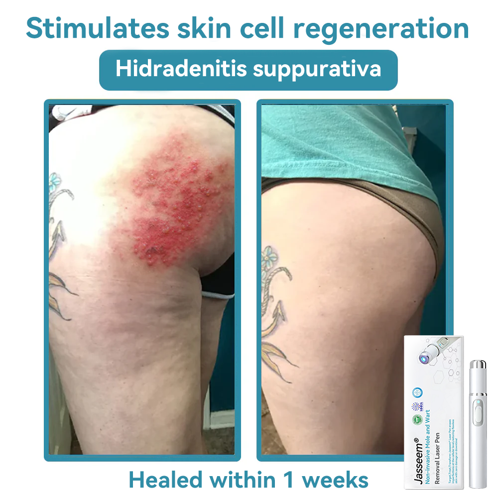 ๐๐๐ฌ๐ฌ๐๐๐ฆยฎ Medical-Grade Laser Pen ๐ (uses COโ laser technology โ effectively removes moles, warts, skin tags, pigmentation spots, and other blemishes)๐ฅ