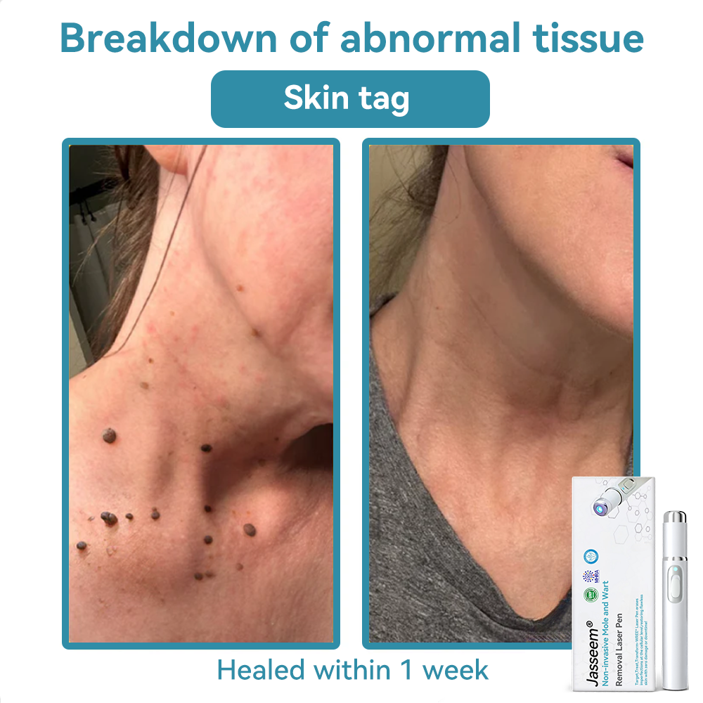 ๐๐๐ฌ๐ฌ๐๐๐ฆยฎ Medical-Grade Laser Pen ๐ (uses COโ laser technology โ effectively removes moles, warts, skin tags, pigmentation spots, and other blemishes)๐ฅ