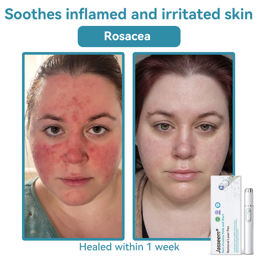 ๐๐๐ฌ๐ฌ๐๐๐ฆยฎ Medical-Grade Laser Pen ๐ (uses COโ laser technology โ effectively removes moles, warts, skin tags, pigmentation spots, and other blemishes)๐ฅ