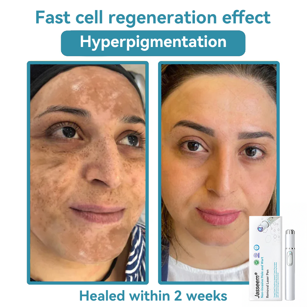 ๐๐๐ฌ๐ฌ๐๐๐ฆยฎ Medical-Grade Laser Pen ๐ (uses COโ laser technology โ effectively removes moles, warts, skin tags, pigmentation spots, and other blemishes)๐ฅ