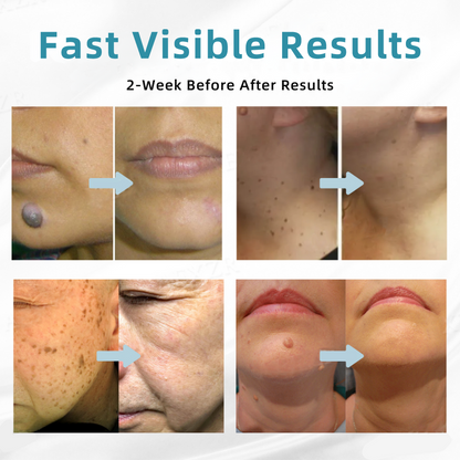 𝐉𝐚𝐬𝐬𝐞𝐞𝐦® Medical-Grade Laser Pen 🎉 (uses CO₂ laser technology – effectively removes moles, warts, skin tags, pigmentation spots, and other blemishes)🔥